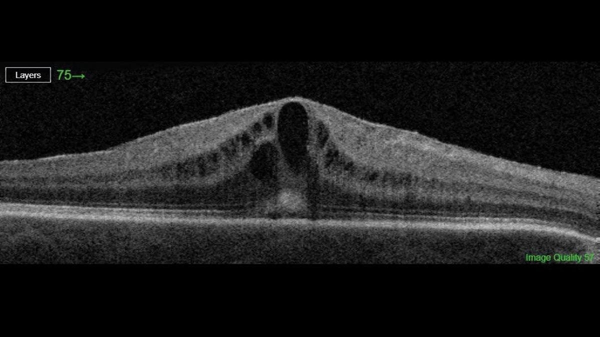 Postoperative cataract surgery complications cystoid macular oedema and epiretinal membrane